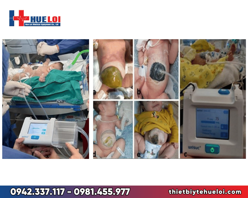 máy hút lực âm chữa lành vết thương