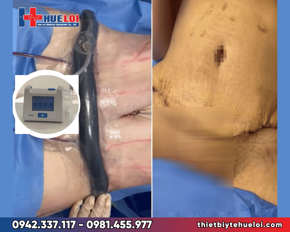 máy hút áp lực âm điều trị vết thương